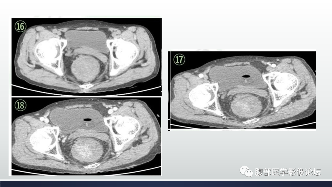 【病例】直肠血管瘤1例CT及MR-7