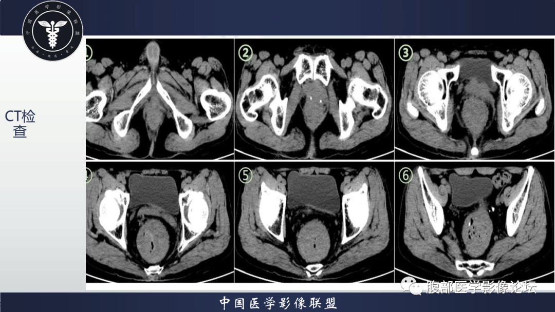 【病例】直肠血管瘤1例CT及MR-3