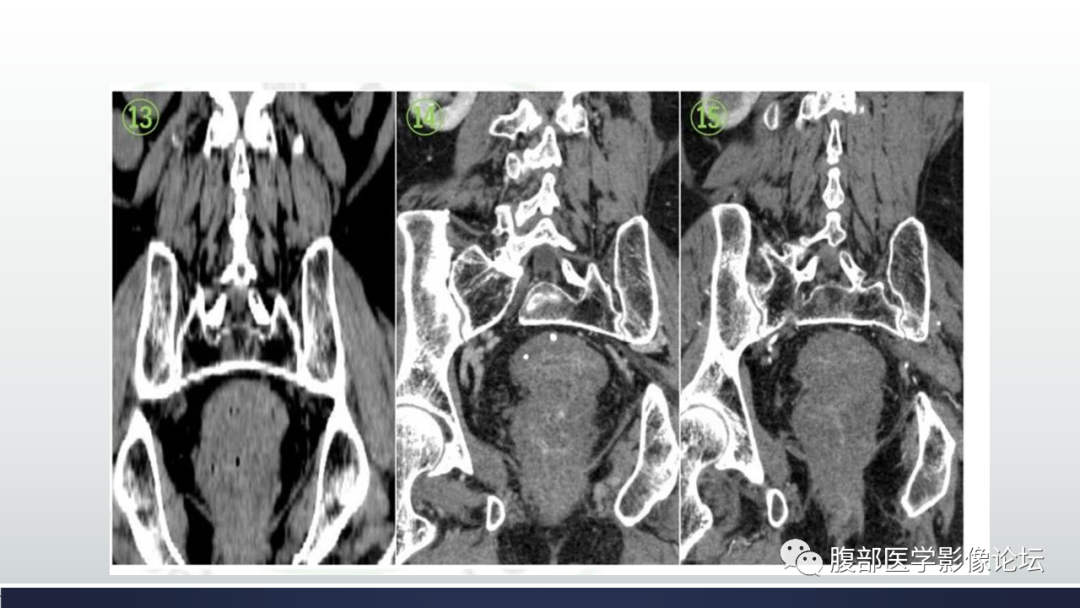 【病例】直肠血管瘤1例CT及MR-6