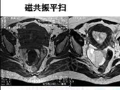 卵巢黏液性囊腺瘤合并子宫内膜异位1例MR