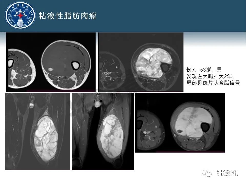 【病例】腹膜后去分化脂肪肉瘤 VS 高分化脂肪肉瘤-31