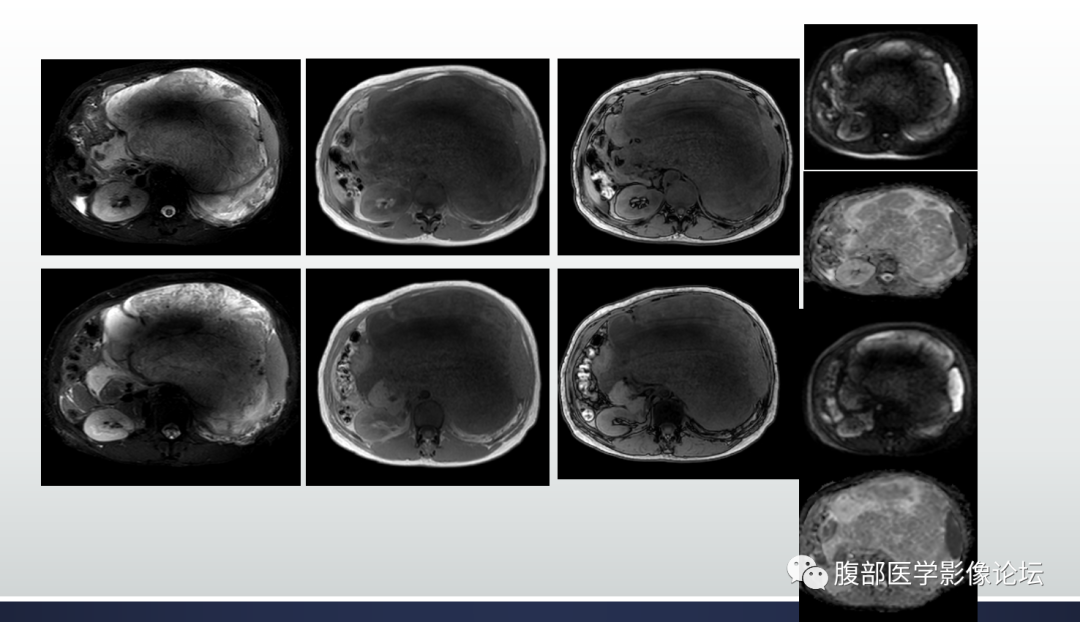 【病例】腹膜后去分化脂肪肉瘤 VS 高分化脂肪肉瘤-9
