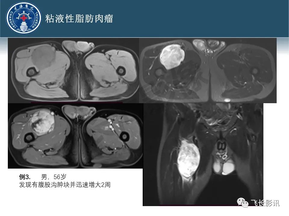 【病例】腹膜后去分化脂肪肉瘤 VS 高分化脂肪肉瘤-27