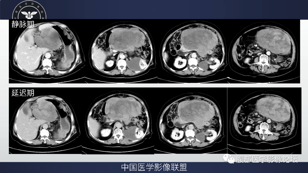 【病例】腹膜后去分化脂肪肉瘤 VS 高分化脂肪肉瘤-4