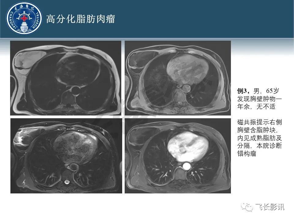【病例】腹膜后去分化脂肪肉瘤 VS 高分化脂肪肉瘤-21