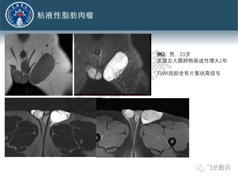 【病例】腹膜后去分化脂肪肉瘤 VS 高分化脂肪肉瘤-26