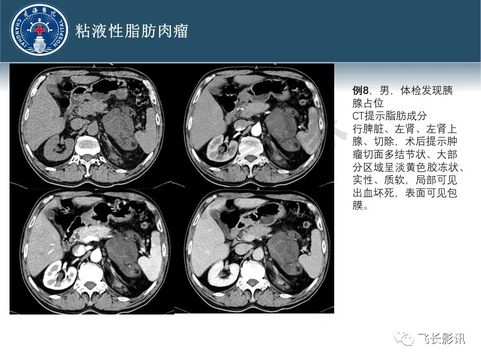 【病例】腹膜后去分化脂肪肉瘤 VS 高分化脂肪肉瘤-32