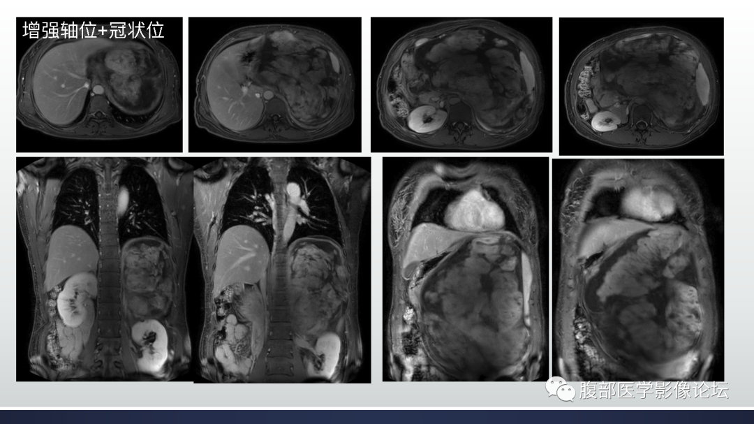 【病例】腹膜后去分化脂肪肉瘤 VS 高分化脂肪肉瘤-10
