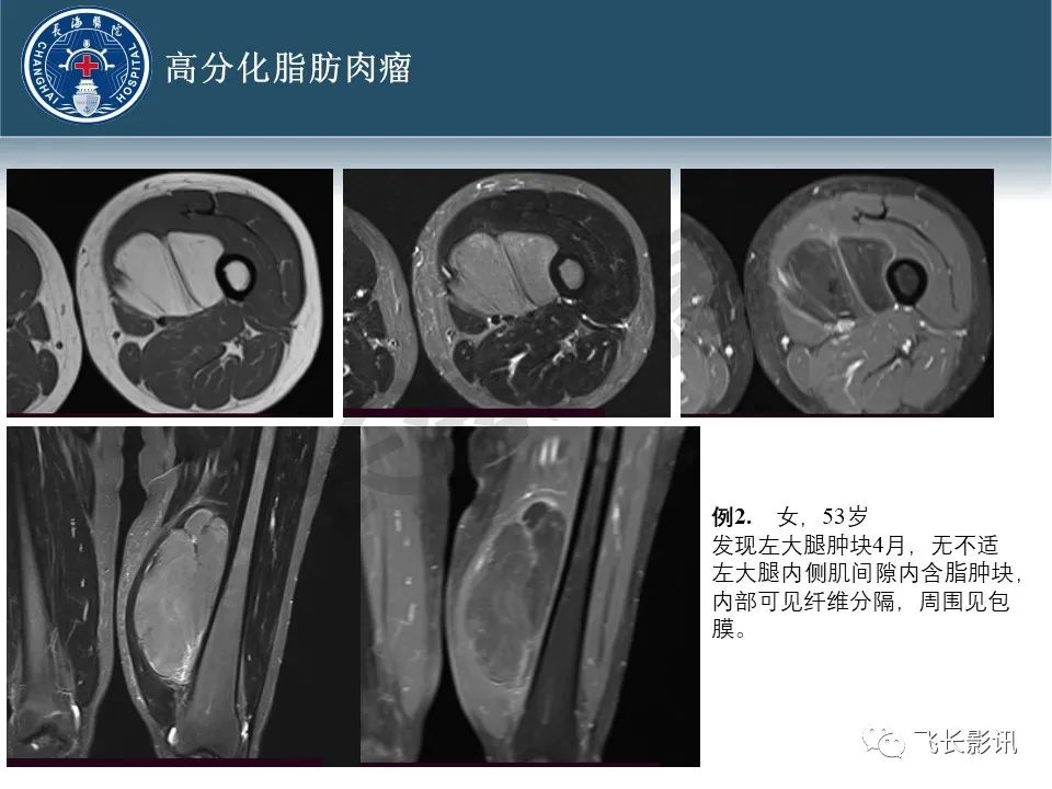 【病例】腹膜后去分化脂肪肉瘤 VS 高分化脂肪肉瘤-20