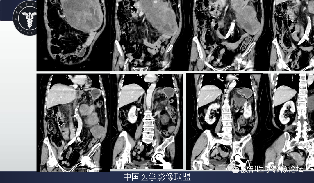 【病例】腹膜后去分化脂肪肉瘤 VS 高分化脂肪肉瘤-5