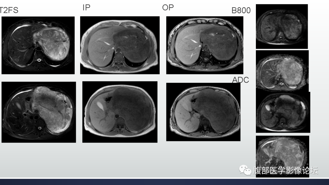 【病例】腹膜后去分化脂肪肉瘤 VS 高分化脂肪肉瘤-8