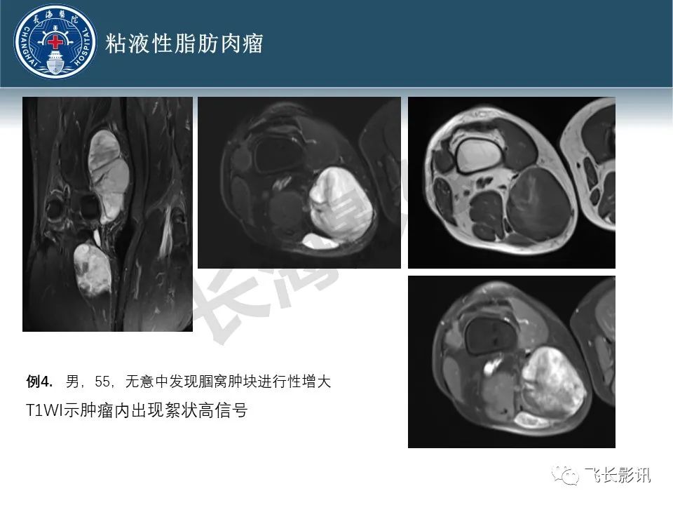 【病例】腹膜后去分化脂肪肉瘤 VS 高分化脂肪肉瘤-28