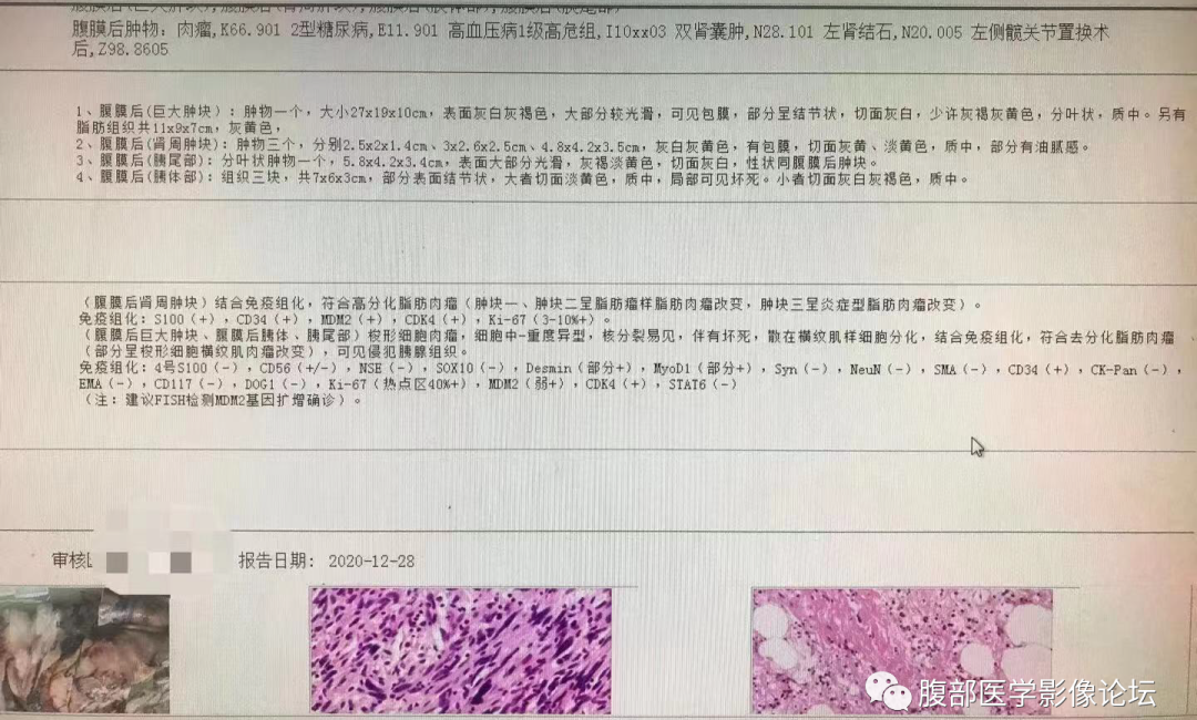 【病例】腹膜后去分化脂肪肉瘤 VS 高分化脂肪肉瘤-11