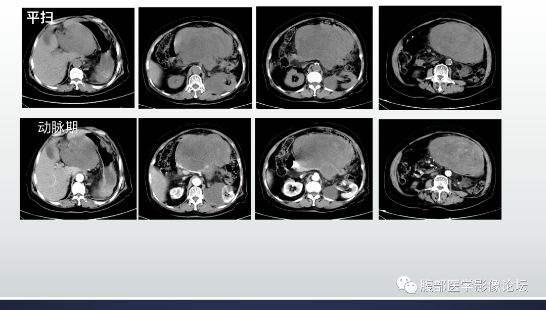 【病例】腹膜后去分化脂肪肉瘤 VS 高分化脂肪肉瘤-3