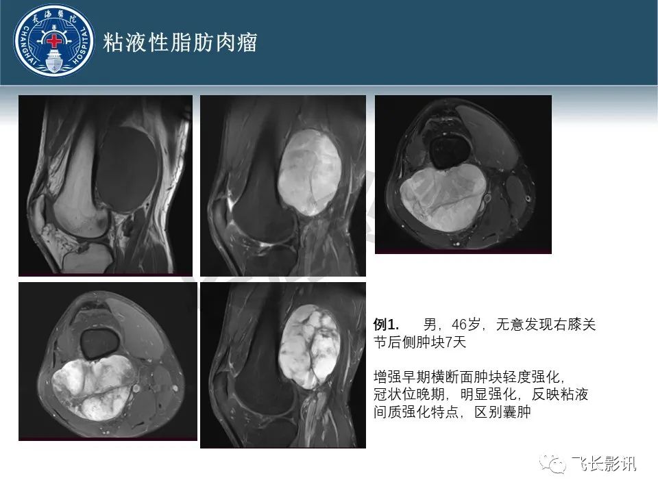 【病例】腹膜后去分化脂肪肉瘤 VS 高分化脂肪肉瘤-25