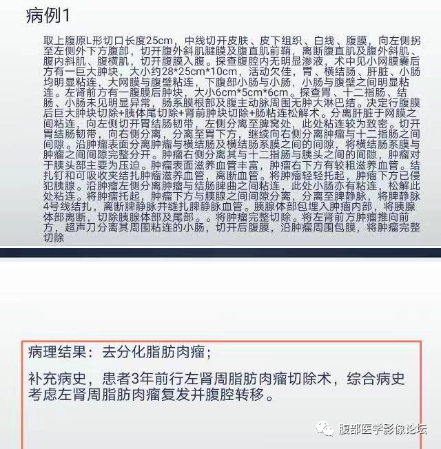 【病例】腹膜后去分化脂肪肉瘤 VS 高分化脂肪肉瘤-6