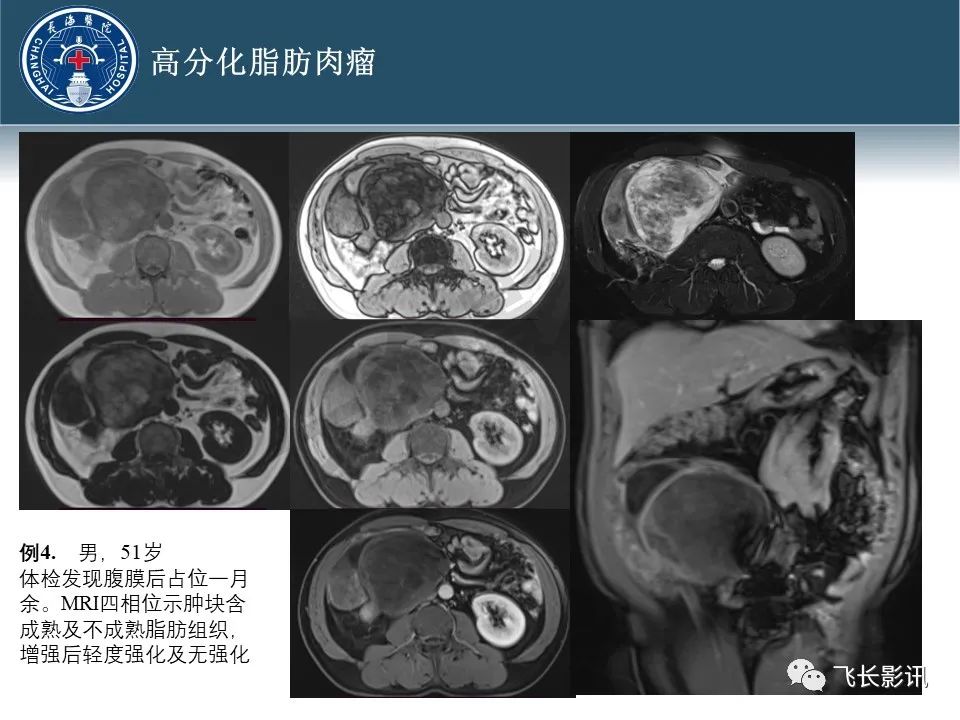 【病例】腹膜后去分化脂肪肉瘤 VS 高分化脂肪肉瘤-22