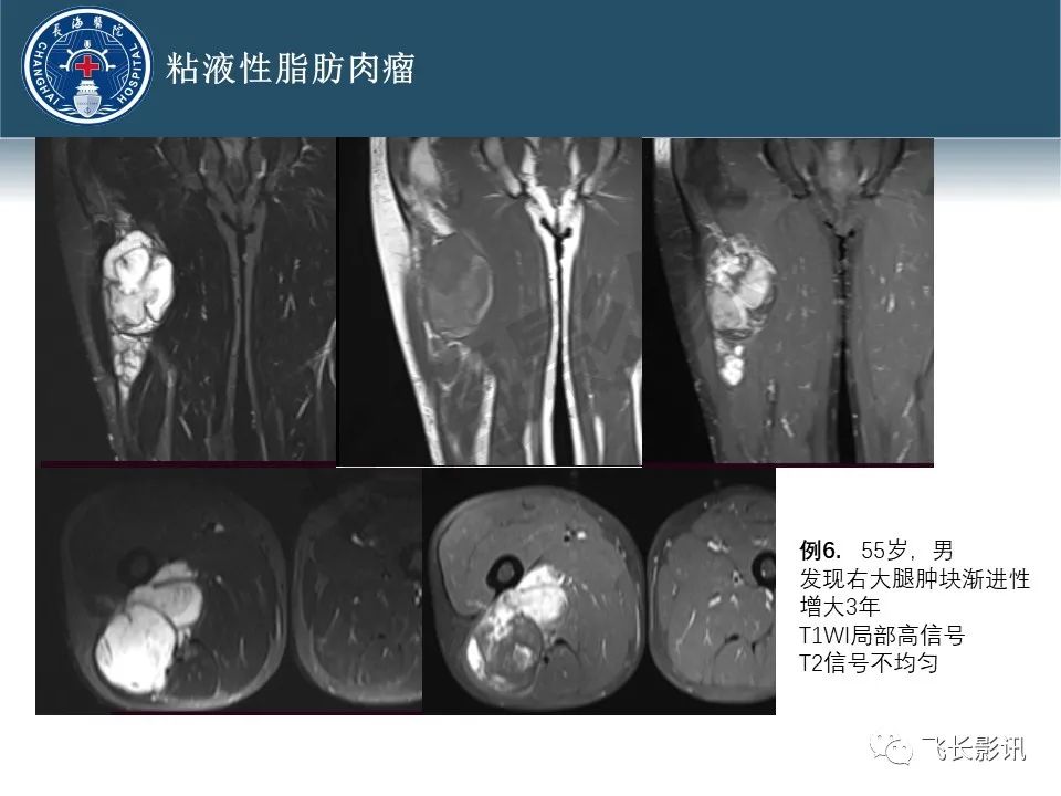 【病例】腹膜后去分化脂肪肉瘤 VS 高分化脂肪肉瘤-30