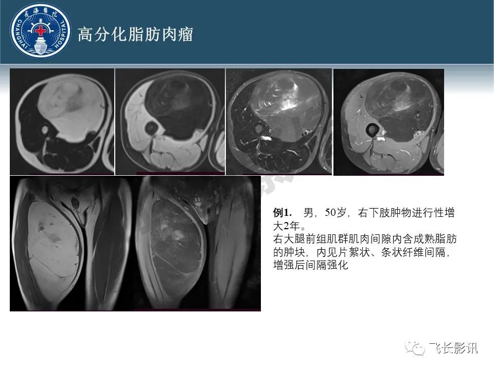 【病例】腹膜后去分化脂肪肉瘤 VS 高分化脂肪肉瘤-19