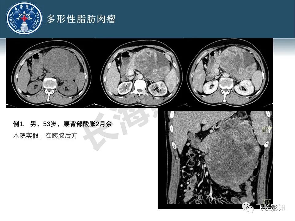 【病例】腹膜后去分化脂肪肉瘤 VS 高分化脂肪肉瘤-53