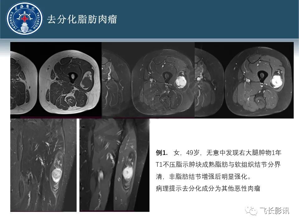【病例】腹膜后去分化脂肪肉瘤 VS 高分化脂肪肉瘤-43