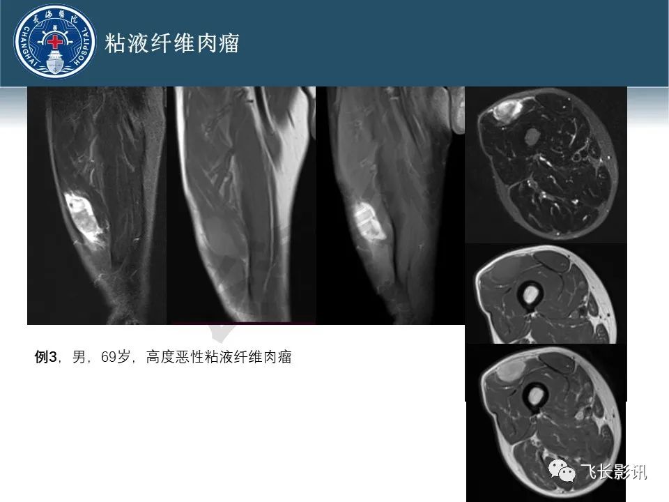 【病例】腹膜后去分化脂肪肉瘤 VS 高分化脂肪肉瘤-38
