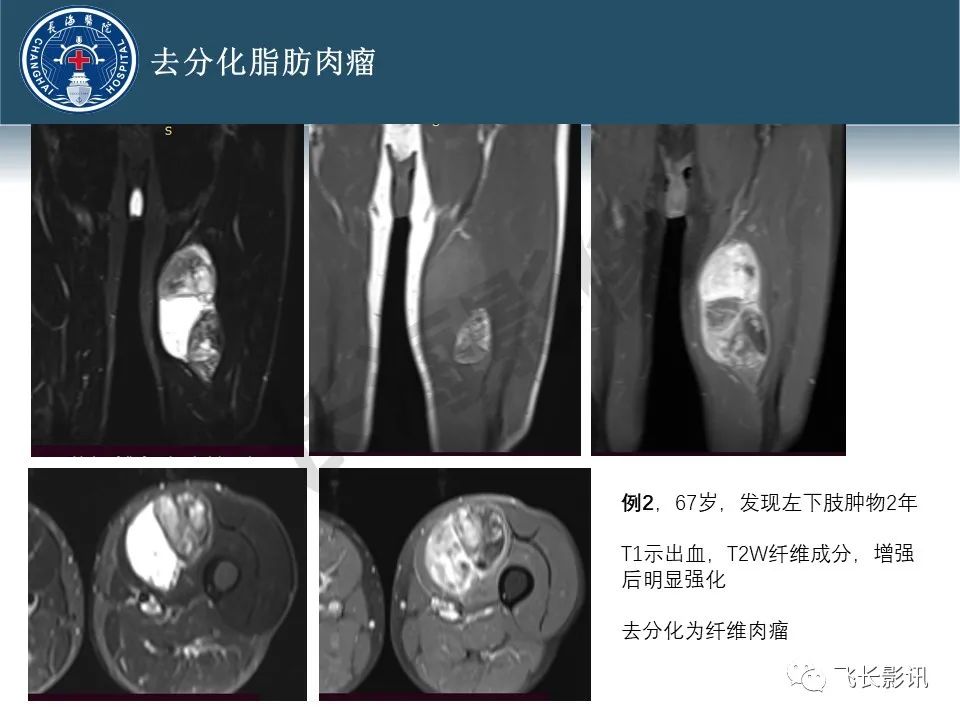 【病例】腹膜后去分化脂肪肉瘤 VS 高分化脂肪肉瘤-44