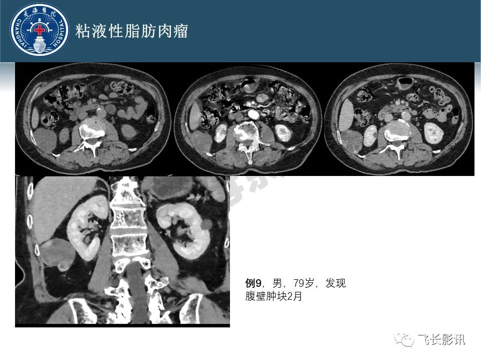 【病例】腹膜后去分化脂肪肉瘤 VS 高分化脂肪肉瘤-33