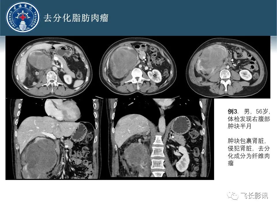 【病例】腹膜后去分化脂肪肉瘤 VS 高分化脂肪肉瘤-45