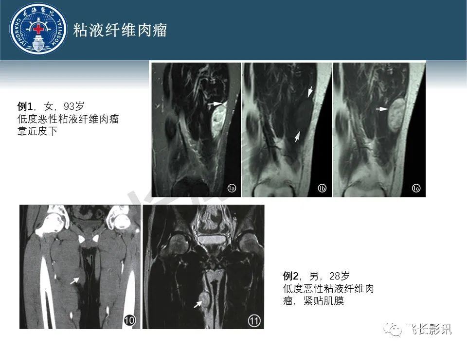 【病例】腹膜后去分化脂肪肉瘤 VS 高分化脂肪肉瘤-37