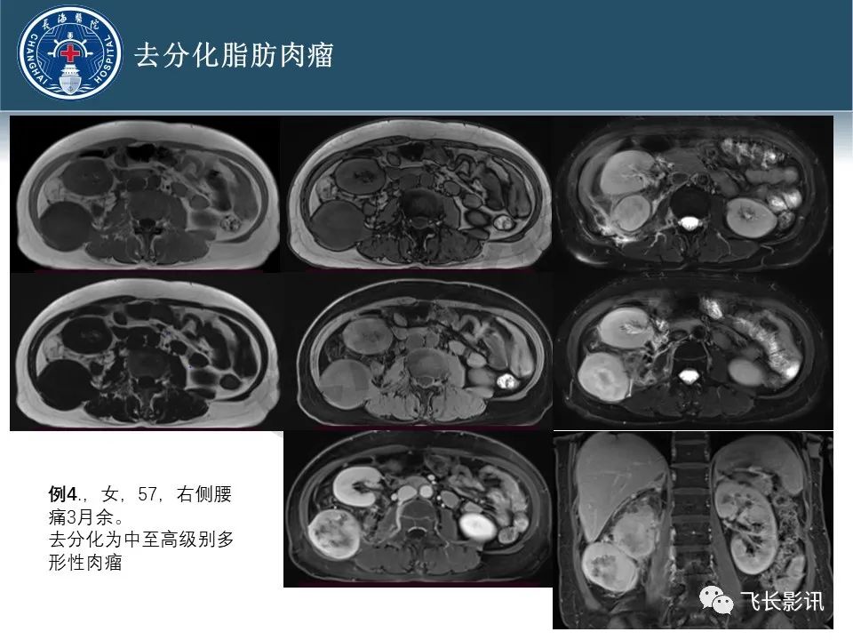 【病例】腹膜后去分化脂肪肉瘤 VS 高分化脂肪肉瘤-46