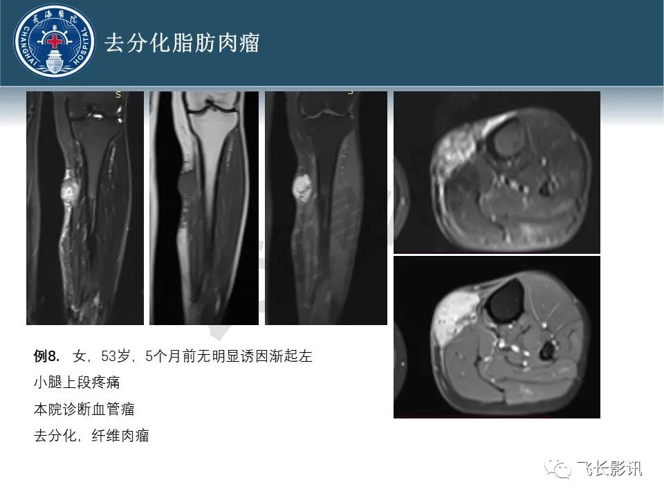 【病例】腹膜后去分化脂肪肉瘤 VS 高分化脂肪肉瘤-50