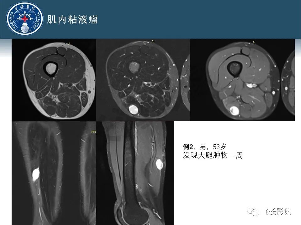 【病例】腹膜后去分化脂肪肉瘤 VS 高分化脂肪肉瘤-40