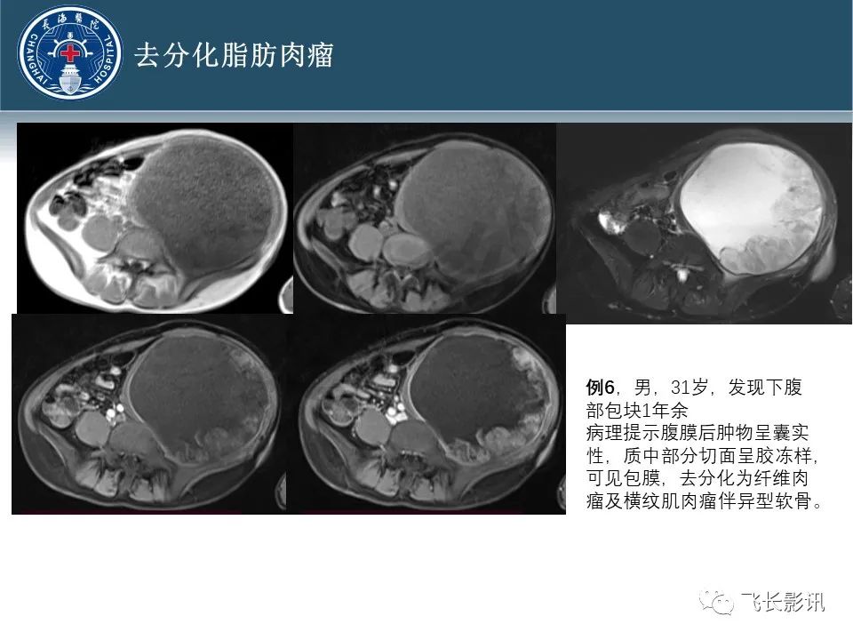 【病例】腹膜后去分化脂肪肉瘤 VS 高分化脂肪肉瘤-48