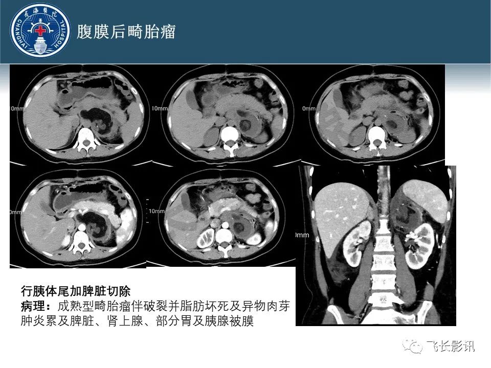 【病例】腹膜后去分化脂肪肉瘤 VS 高分化脂肪肉瘤-58