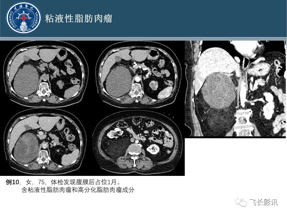 【病例】腹膜后去分化脂肪肉瘤 VS 高分化脂肪肉瘤-34