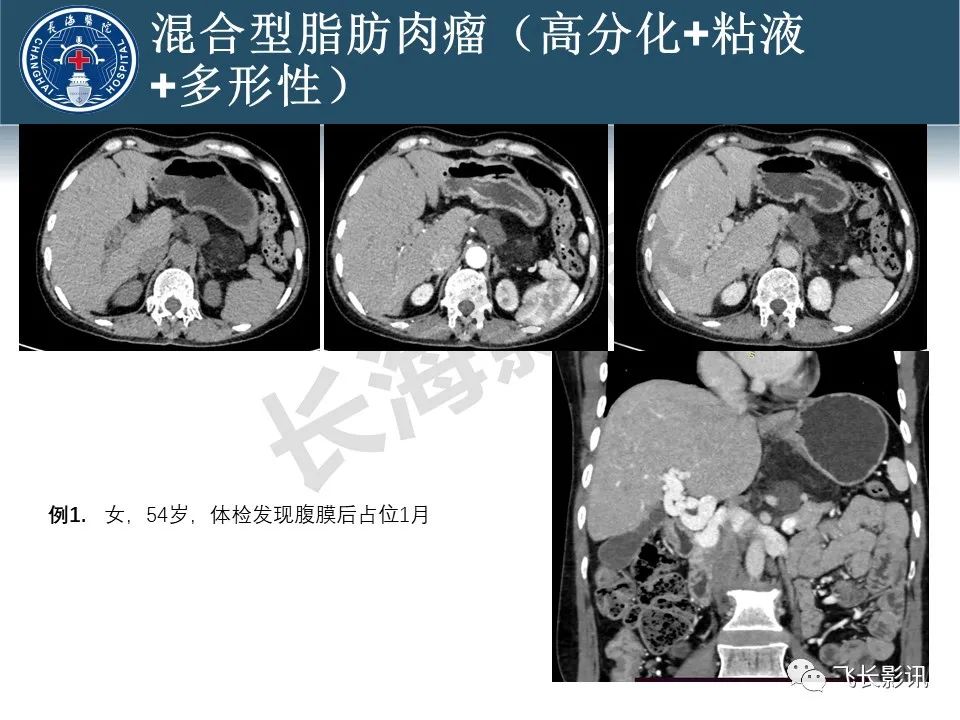 【病例】腹膜后去分化脂肪肉瘤 VS 高分化脂肪肉瘤-54