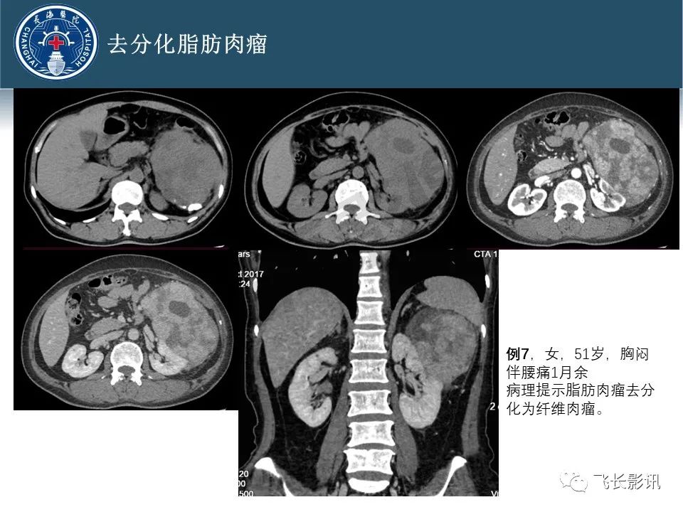 【病例】腹膜后去分化脂肪肉瘤 VS 高分化脂肪肉瘤-49