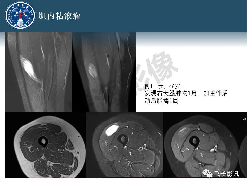 【病例】腹膜后去分化脂肪肉瘤 VS 高分化脂肪肉瘤-39
