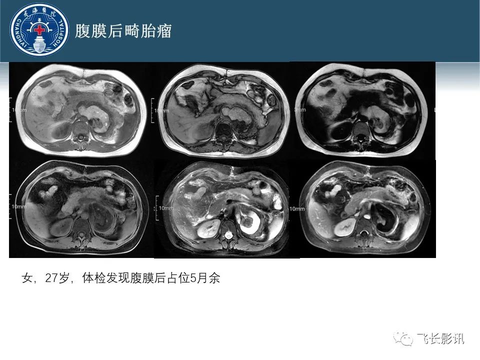 【病例】腹膜后去分化脂肪肉瘤 VS 高分化脂肪肉瘤-57