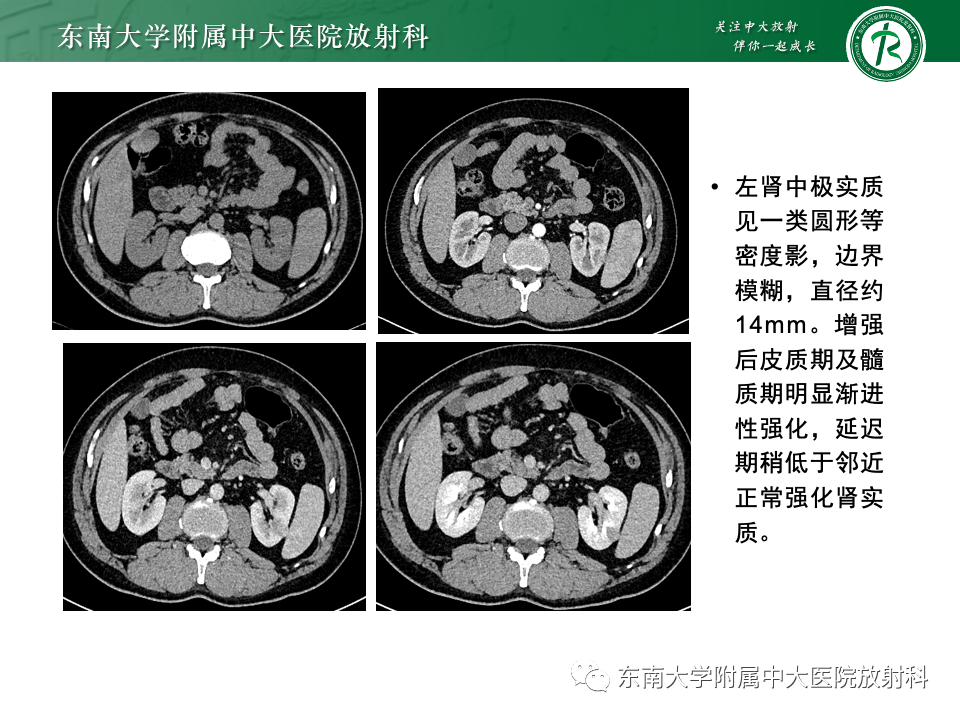 【PPT】肾透明细胞癌-4