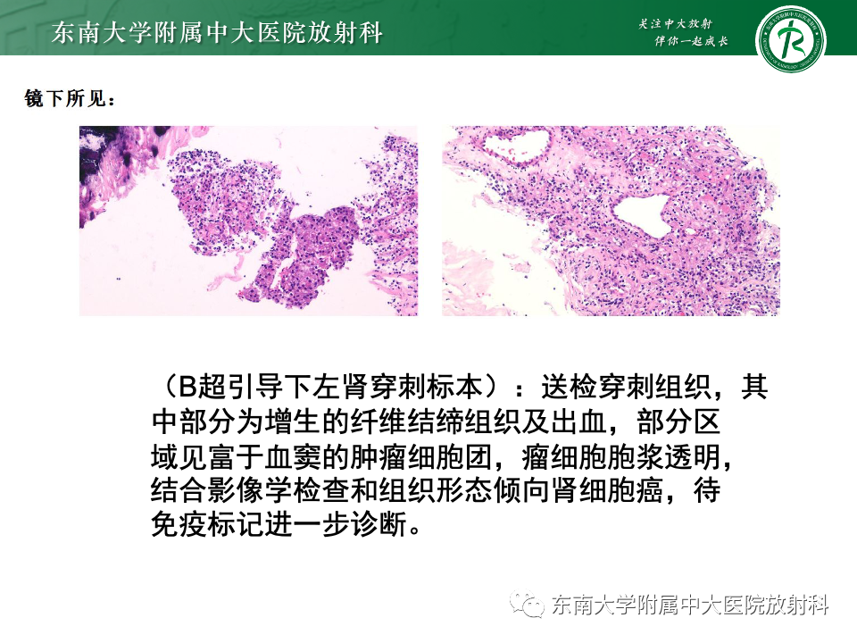 【PPT】肾透明细胞癌-8