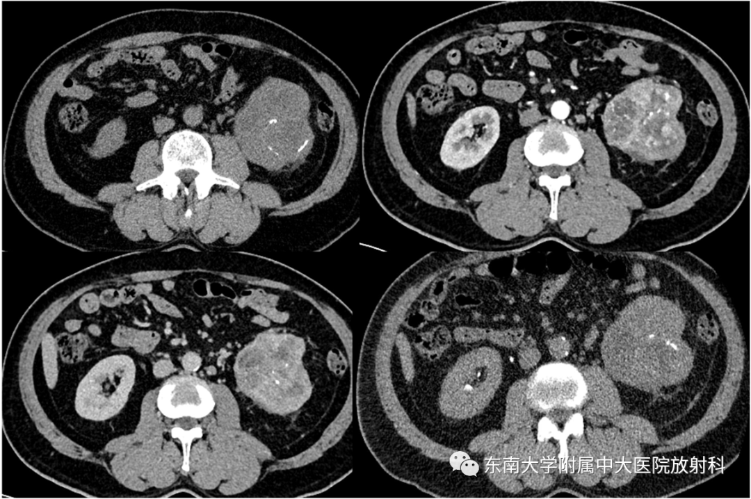 【PPT】肾透明细胞癌-2