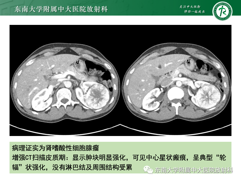 【PPT】肾透明细胞癌-23