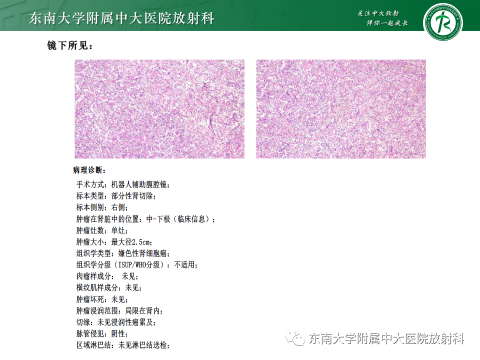 【PPT】肾透明细胞癌-15