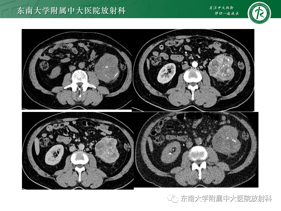 【PPT】肾透明细胞癌-7