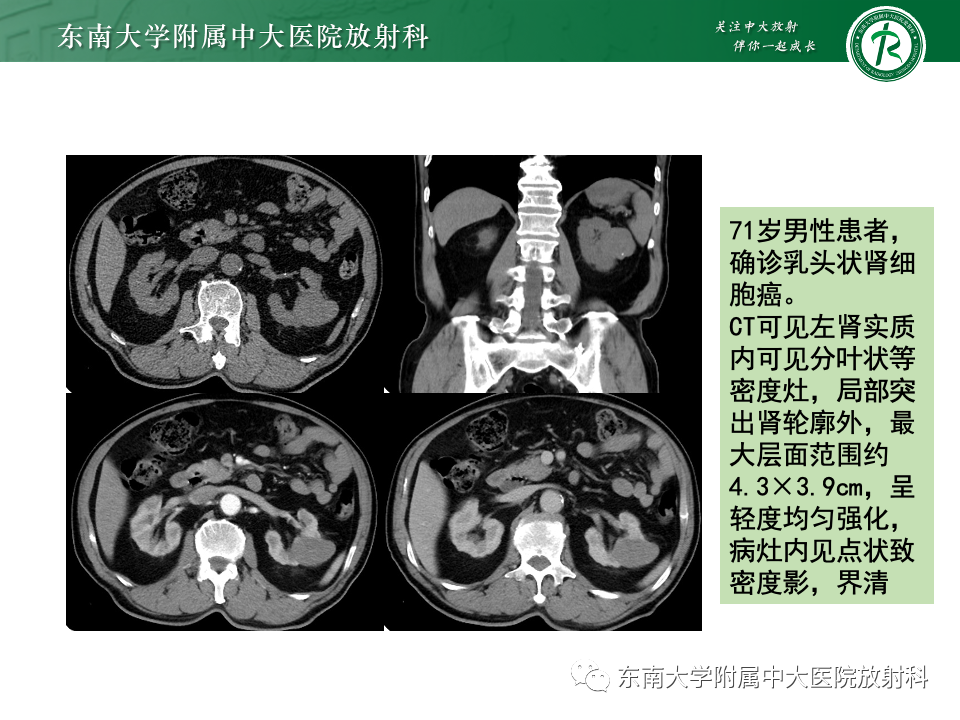 【PPT】肾透明细胞癌-20