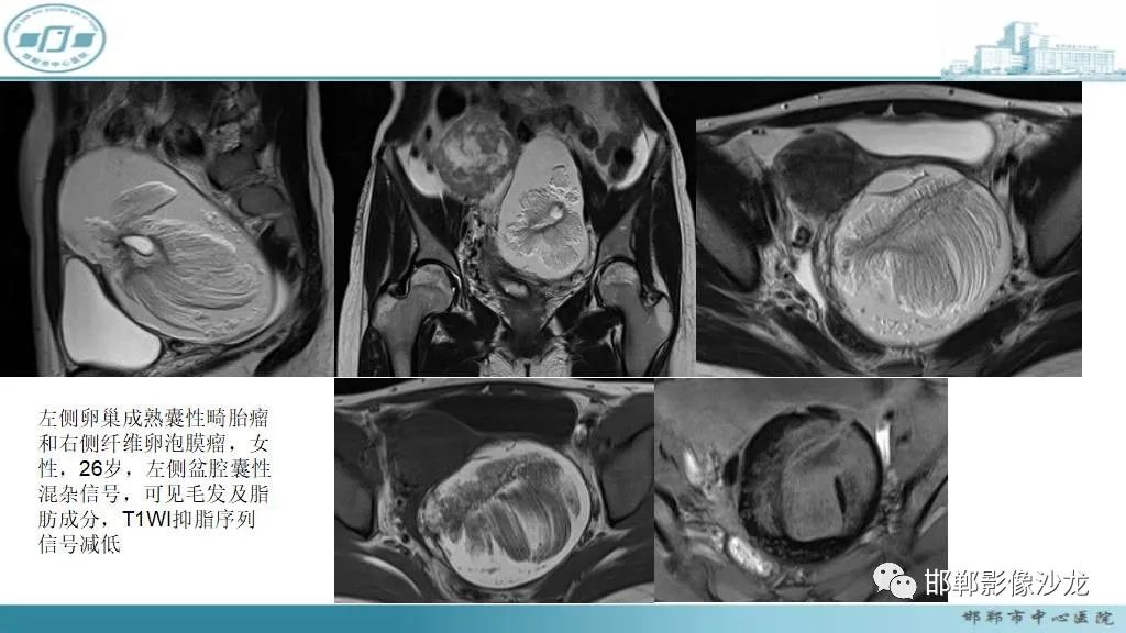【病例】卵巢甲状腺肿1例CT影像-21