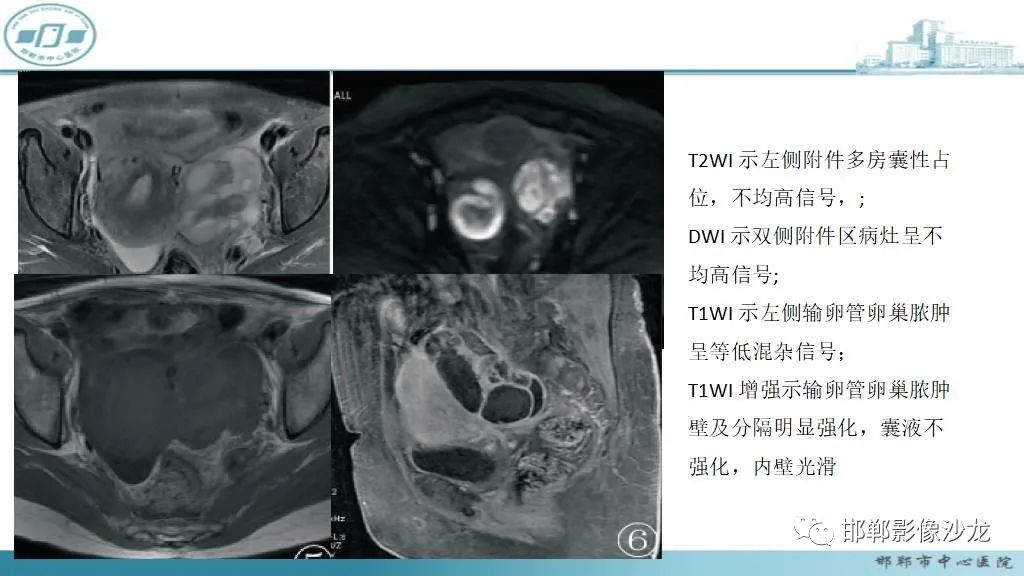 【病例】卵巢甲状腺肿1例CT影像-36