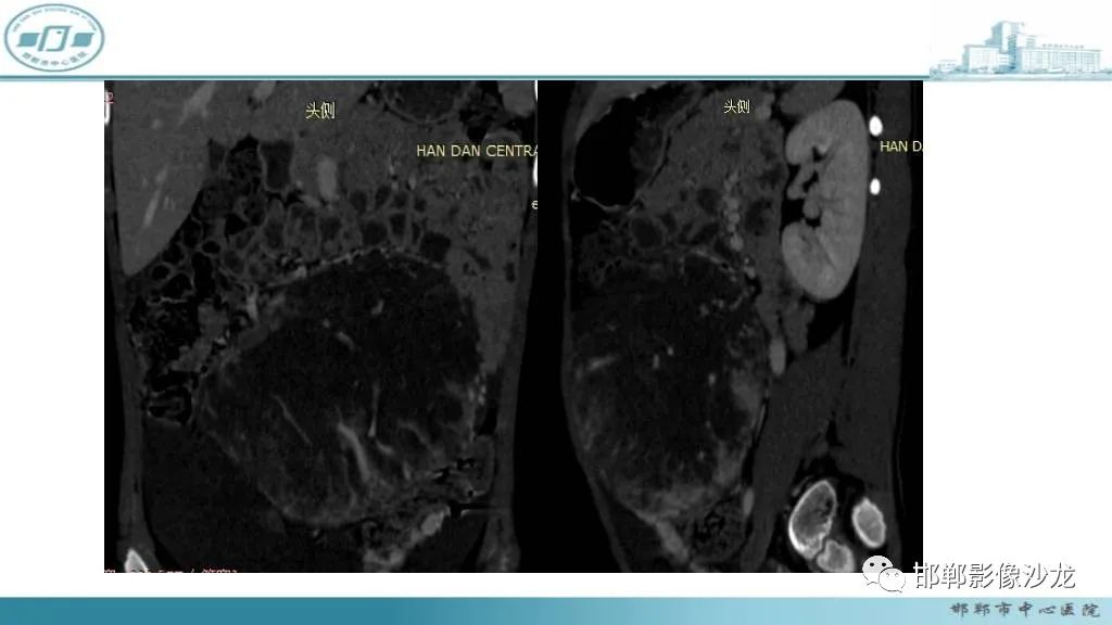 【病例】卵巢甲状腺肿1例CT影像-29